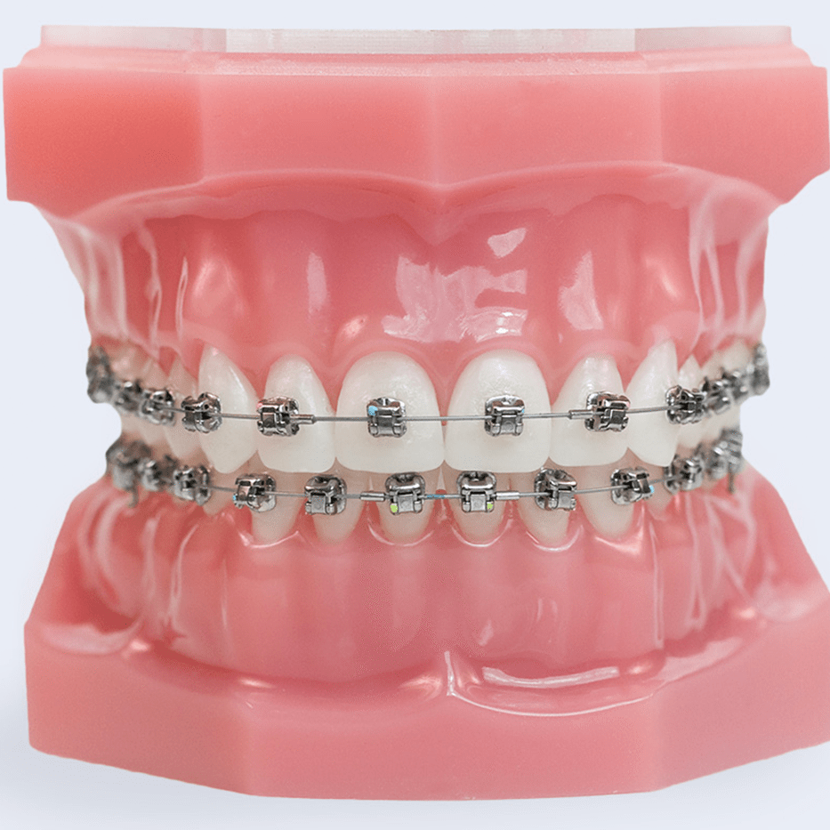 braces eagle mountain